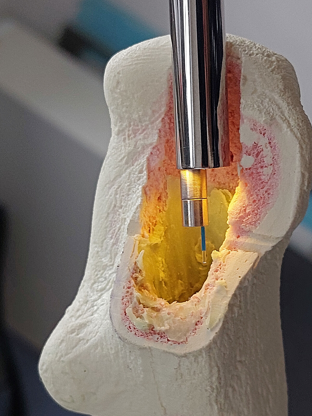 Das Modell zeigt einen offenen und beleuchteten Knochenschaft, in den die Laserfaser in einem Arbeitskanal durch ein starres Endoskop geführt wird. 